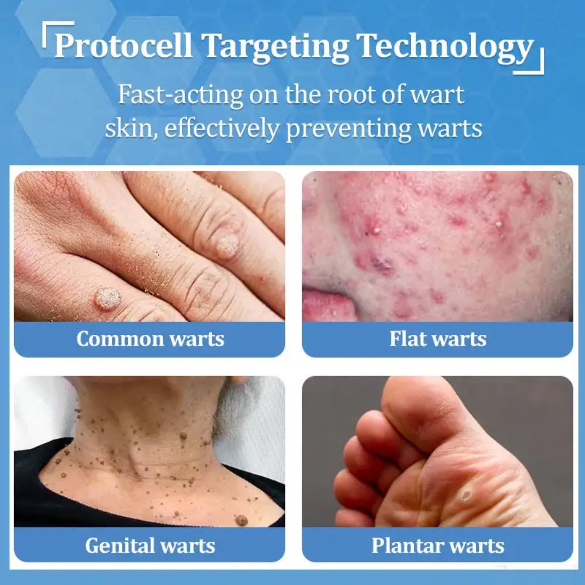 The Last Wart Treatment You’ll Ever Buy