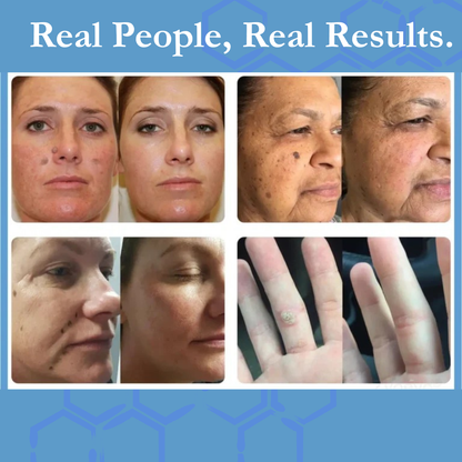 The Last Wart Treatment You’ll Ever Buy